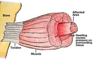 Compartment Syndrome