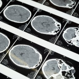 Pittsburgh Brain Injury attorney