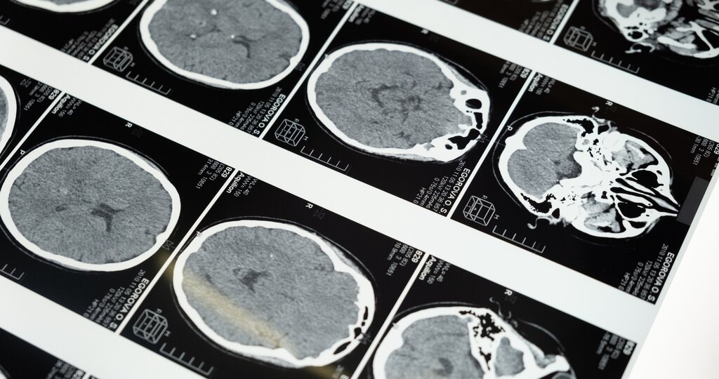 Pittsburgh Brain Injury attorney