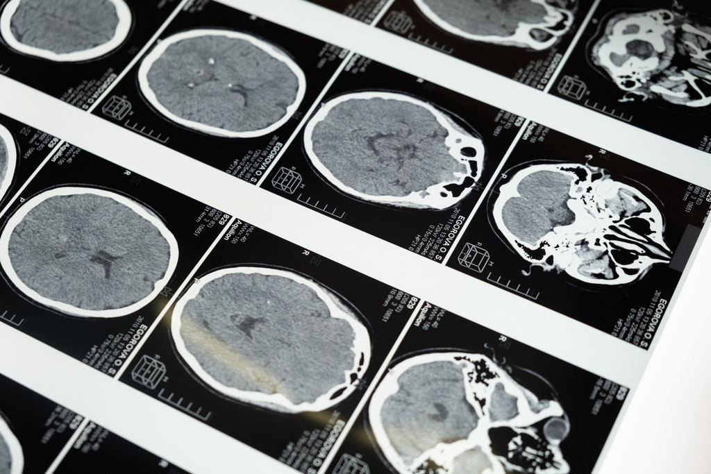 Traumatic Brain Injury and Your Rights 1 Pittsburgh Brain Injury attorney